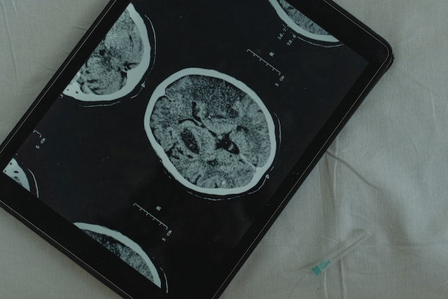 How AI Holds Promise in Preventing Alzheimer's Disease