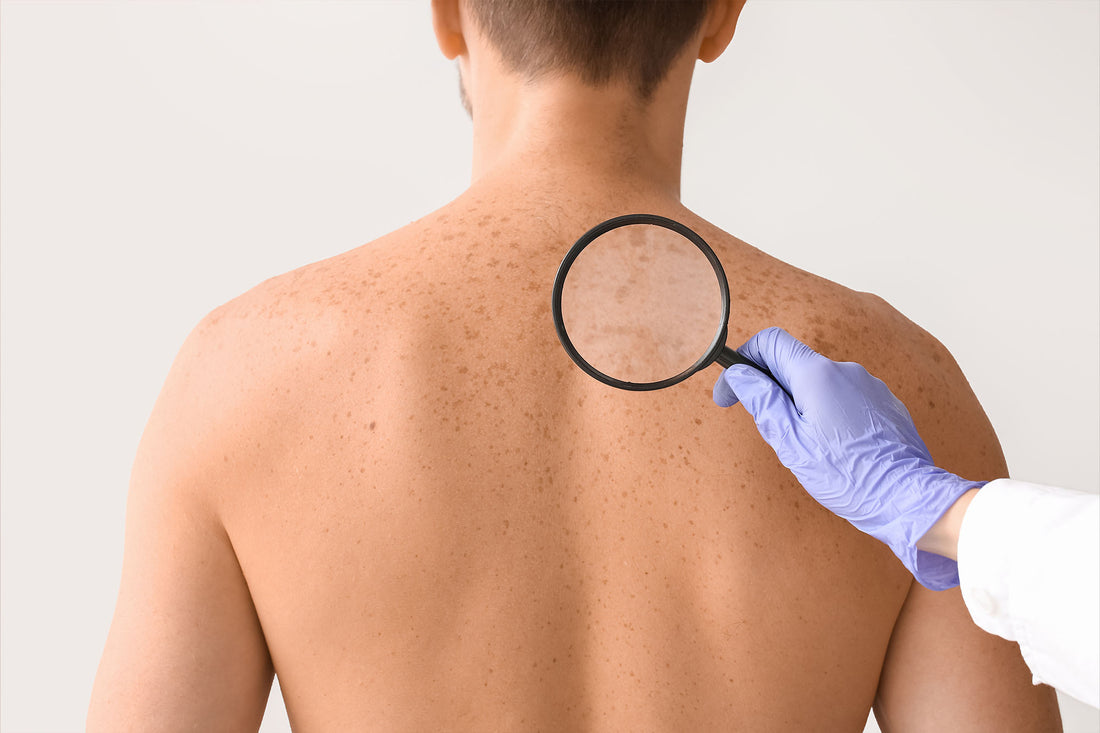 Skin Cancer: How to Examine Your Own Skin